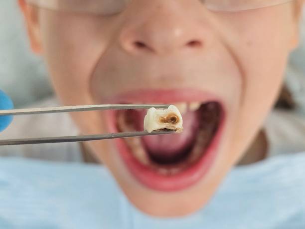 Best Emergency Dentist for Lost Fillings or Crowns in Albany, GA